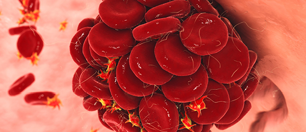 Un nouvel anticoagulant sans risque d’hémorragie